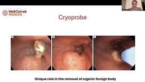Foreign Body Removal: Overview of Bronchoscopic Techniques