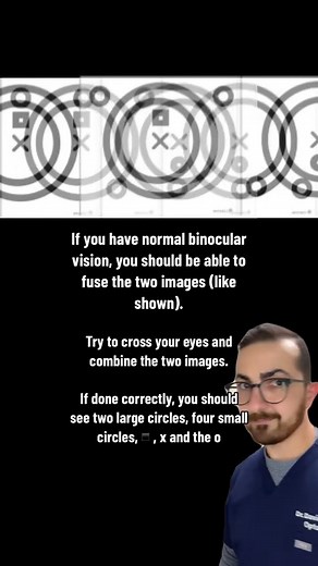 This Binocular Vision Test checks for your ability to cross your eyes and fuse the seperate images s