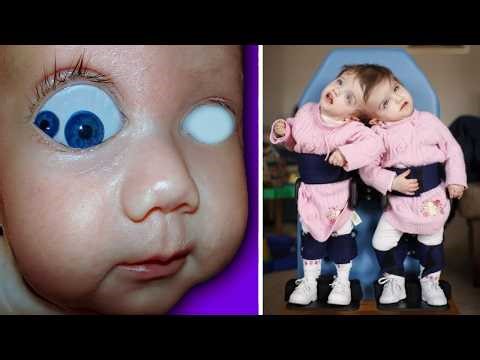 15 Incredible Rare Kids Born With the most STRANGE Features!