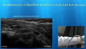 Diagnostic Ultrasound for Overhanging Subdeltoid Bursitis in a 52 year-Old Female