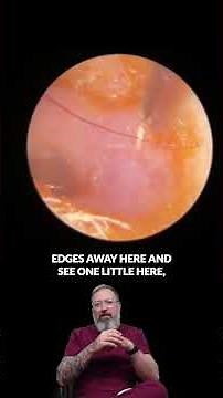 The Olive Oil Solution for Ear Wax! Does It Really Work 🤔👂