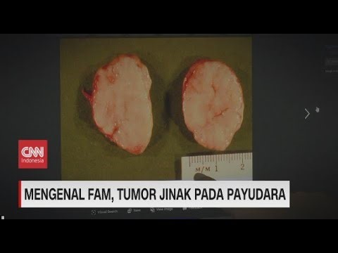 Mengenal FAM, Tumor Jinak Pada Payudara
