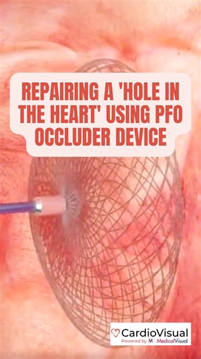 CardioVisual: Powered by MedicalVisual | A patent foramen ovale (PFO) may be a small ‘hole in the heart’, but can lead to a stroke. This animation shows the deployment of a PFO... | Instagram
