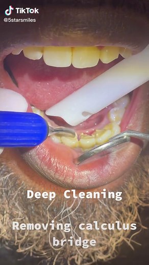 Effective Teeth Cleaning Techniques for Calculus Removal