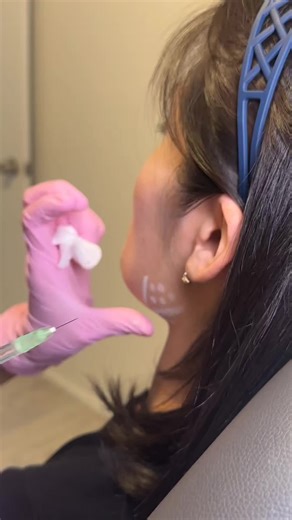 Jawline Botox Sliming face & TMJ #botox #xeomin #jawline #kbeauty #medspanyc