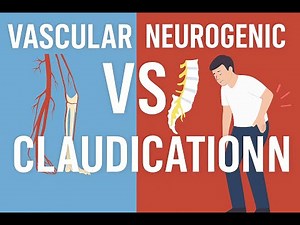 Vascular vs Neurogenic Claudication