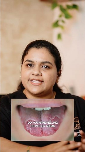 What Is Geographic Tongue?#GeographicTongue #OralHealth #SkinConditions #TongueHealth