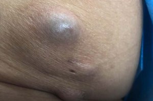 Huge Cyst Explosion and Sack Removal