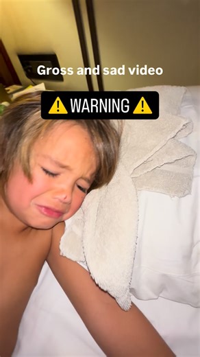 The Bucket List Family on Instagram: "GRAPHIC WARNING ⚠️ This is called a bot fly! We didn’t even know this was a thing!! 😱 the bot fly will bite you and implant an egg into your skin where it incubates, hatches, grows, and will eventually climb out on its own and fly away!!?!! 😨😱😰 Cali had been complaining about pain from what we simply thought was a pimple..UNTIL WE SAW IT MOVING!! That’s when @garrettgee grabbed some tweezers and went to work. If you know Garrett then you know he had to s