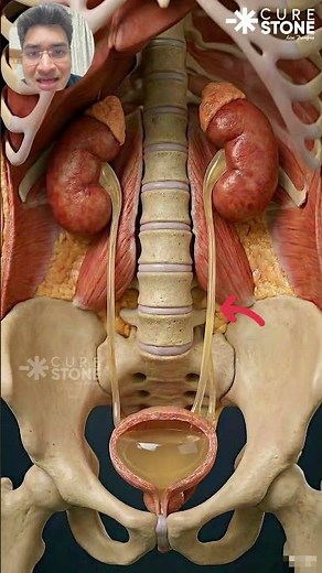 The 3-4mm Rule: Why Your Kidney Stone WON'T Pass On Its Own 🤯 | Dr. Deepanshu Gupta (Top RIRS)