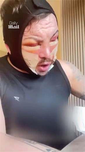 TOWIE star Bobby Norris, 39, shows heavily swollen and bandaged face after facelift as he calls out ‘judgy’ strangersFormer TOWIE star Bobby Norris has shared his raw recovery in Turkey after undergoing a full face lift, neck lift and lower blepharoplasty in March 2026.The 39-year-old posted an Instagram video on May 12 wearing a tight compression garment, his face extremely swollen and bandaged, as he stepped outside for fresh air.He revealed he was given a disgusted look by a woman he describe