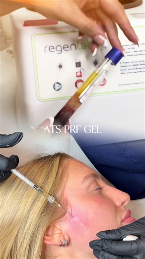 Why settle for a liquid shot when you can have a 10-day slow-release 'factory' of youth? 🧪 The Regen Lab ATS PRF Gel Difference: \t•\t100% Natural: No chemicals or heat. It uses your own body’s thrombin to turn your plasma into a