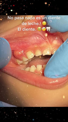 Treating Tooth Cavities: Dental Procedure Insights