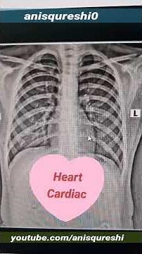 Basic Chest X-Ray Pathologies Explained 🫁 | Emphysema to Pneumonia #radiologyeducation