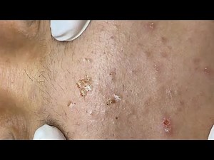 Soothing Facial & Deep Cleansing Spa (ASMR) | Ultimate Stress Relief & Relaxation