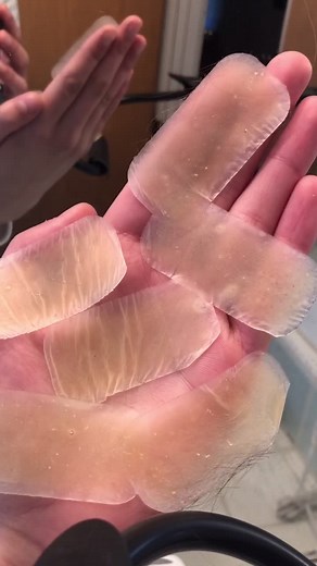 Hydrocolloid Bandages for Acne: Results and Progress