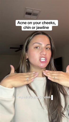 After fighting my cystic hormonal acne for 6 years, I finally started working on fixing what was happening internally and this made allll the difference in clearing my skin once and for all! If you are sick of trying bandaid fixes and things that don’t work, I definitely recommend focusing on fixing what’s happening inside so that you can get that glowy skin outside! @CLEARSTEM Skincare #acneskincare #acnetreatments #acnefree #acnehelp #clearskin