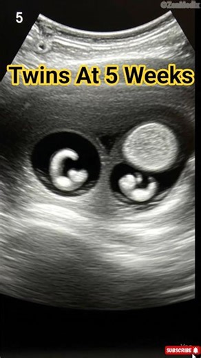 5 Week Twin Pregnancy | Baby Development Inside the Womb