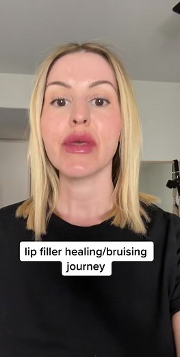 Lip Filler Healing Journey: Day-by-Day Timeline and Tips