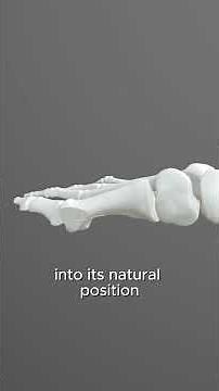 This New Bunion Technique Is 100% Biological – Shark Screw® #bunion #sharkscrew #halluxvalgus