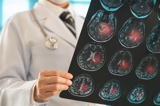 Des chercheurs dévoilent pour la première fois les zones précises du cerveau impliquées dans la dépression - Psychologies.com