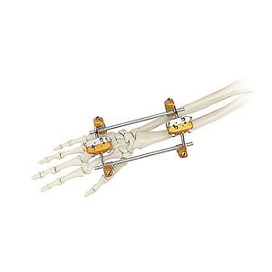 [Hot Item] Orthopaedic Implants Leg Foot Hand Fracture Joint Spanning External Fixator