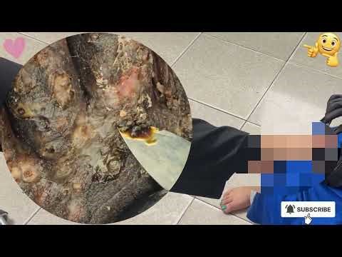 ⚠️ Extreme Jigger Infestation – Cracked Skin Peeled Off Clean! #KR271