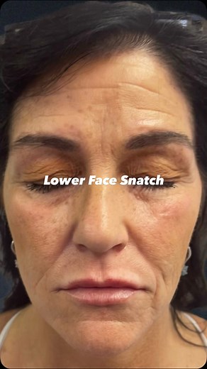 No overfilling. No “filler face.” Just balanced, snatched,...