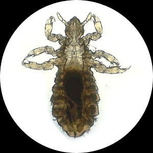 The 411 On Head Lice