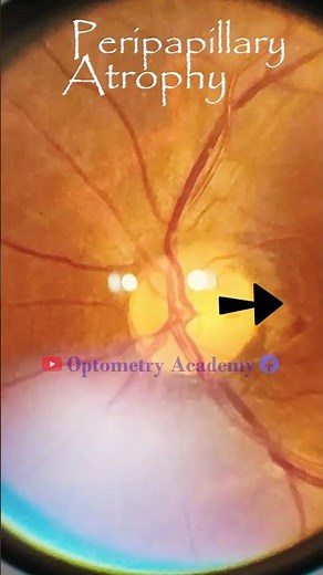 Peripapillary Atrophy | Diabetic retinopathy | Fundus Photography | Short Video 458