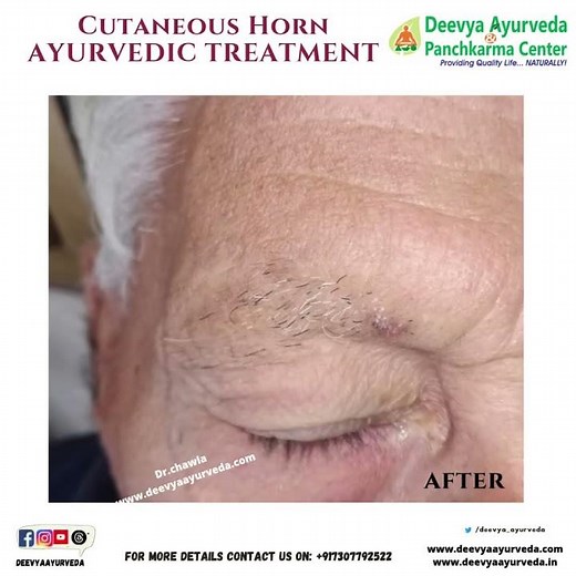 Cutaneous horn removal | Ancient Ayurvedic Heat Therapy #skinproblem #agnikarma