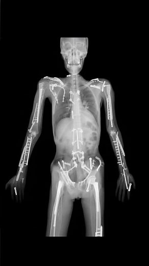 The image shows an X-ray of Travis Pastrana's body, a professional stuntman, revealing metal plates,