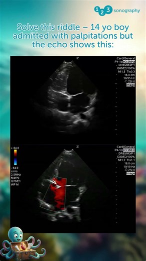 Which heart defect best explains the echo findings? 🫀🔍