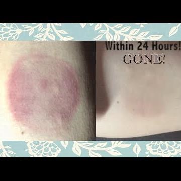 How To Get Rid of Your Cupping Marks or Hickeys Within 24 Hours!
