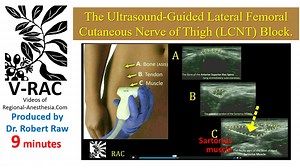 RR10 Lateral Cutaneous Femoral Nerve of Thigh block - ultrasound guided