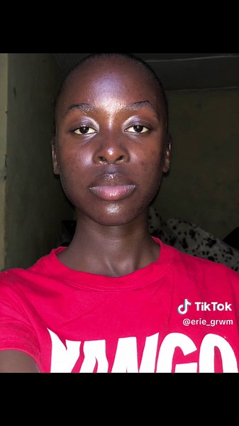 Acne Journey: How I Cleared My Skin — Erie Acne Story