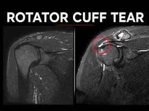 What a Rotator Cuff Tear Looks Like on MRI