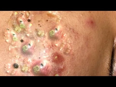 𝐂𝐫𝐚𝐳𝐲 𝐒𝐚𝐭𝐢𝐬𝐟𝐲𝐢𝐧𝐠 𝐁𝐥𝐚𝐜𝐤𝐡𝐞𝐚𝐝 𝐑𝐞𝐦𝐨𝐯𝐚𝐥#139