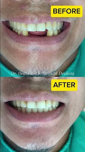 Replacing missing front teeth|Removable partial denture-Dr. Swostik Devkota- Esthetic Transformation