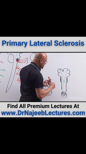 Primary Lateral Sclerosis. Primary Lateral Sclerosis (PLS) is a rare, slowly progressive neurodegenerative disorder characterized by the selective deterioration of upper motor neurons, leading to muscle weakness and stiffness, primarily affecting the legs and potentially the arms and speech/swallowing muscles. | Dr. Najeeb