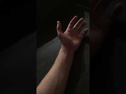 Wrist fracture progress 4 months after surgery