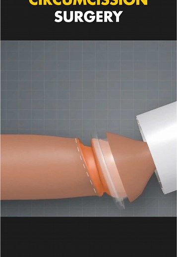 How ZSR Circumcission Surgery Is Performed? (3D Animation) #circumcission #circumcision #circumcissionsurvivor🙏 #circumcissionsurgery #circumcissionsurvivor #medical3danimation #3dmedicalanimation #genderchange #genderaffirmingsurgery