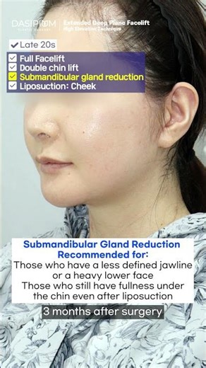 Submandibular gland reduction #facelift #extendeddeepplanefacelift #Submandibularglandreduction