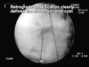 Renal cyst punctured During PCNL procedure