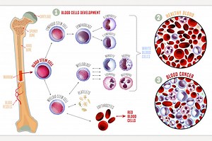 Leukemia medical infographic, a Healthcare Illustration by Anna's Shop