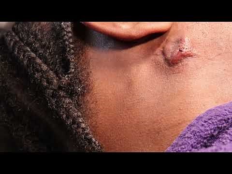 First Cyst Removal Of 2024 😱😎🫣