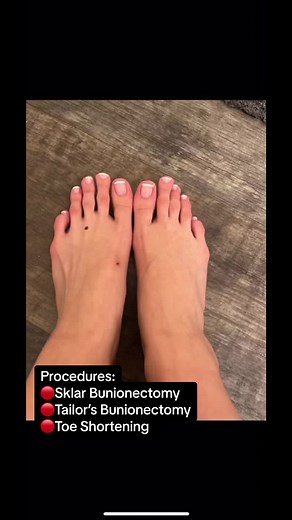Long Toes: Toes Shortening Procedure for Insecure Feet