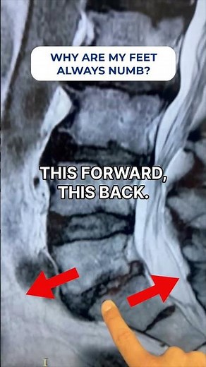 Feet numb or tingling? Spinal nerves could be the cause—discover relief! #NeuropathyRelief