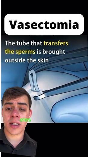 How is the procedure performed to prevent a man from having more children? #vasectomy #shorts