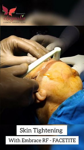 Skin Tightening with Embrace Rf Facetite for Facial Rejuvenation & Youthful Skin